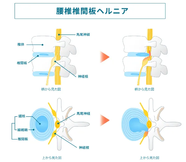 ヘルニアの説明画像
